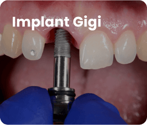 Implant Gigi