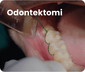 Odontektomi
